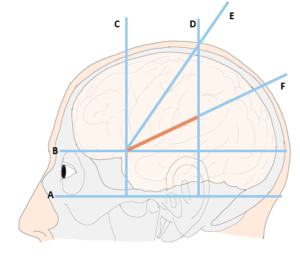頭蓋縫合 シルビウス裂 (sylvian fissure)の場所を術前に同定する方法